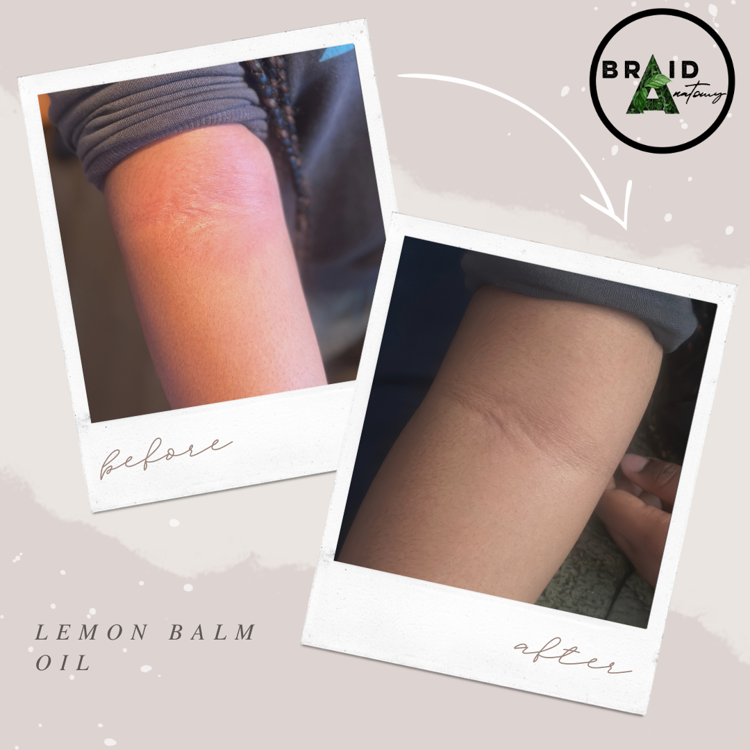 Our Lemon Balm has been proven to treat allergic reactions.